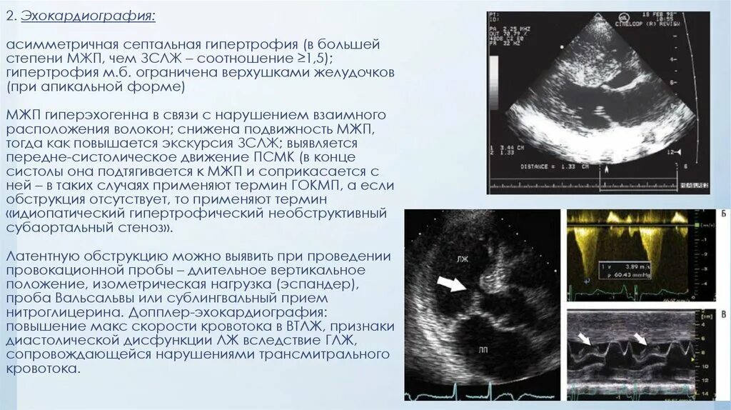 Механизмы декомпенсации сердечной недостаточности. Степени гипертрофии. При выраженной гипертрофии правого желудочка. Три стадии гипертрофии миокарда. Аварийная стадия гипертрофии миокарда.