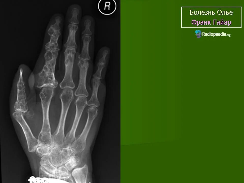 Болезнь олье. Хондроматоз костей (дисхондроплазия). Болезнь олье. Болезнь олье. Болезнь олье у детей клинические рекомендации.