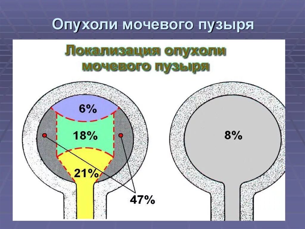 Локализация опухоли мочевого пузыря. Опухоли мочевогоп пузыря. Объемное образование мочевого пузыря. Раковая опухоль мочевого пузыря. Операция рака мочевого пузыря у мужчин