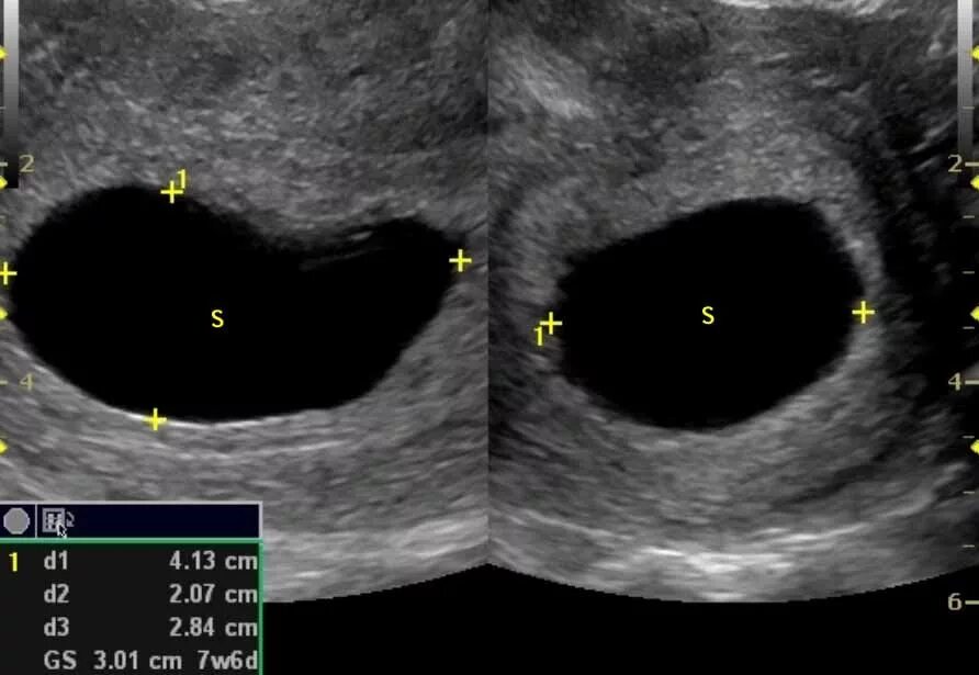 Неразвивающаяся беременность УЗИ. Плодное яйцо анэмбриония. Анэмбриония – пустое плодное яйцо. Анэмбрионии неразвивающейся беременности. Не видно плодного яйца на 5 неделе
