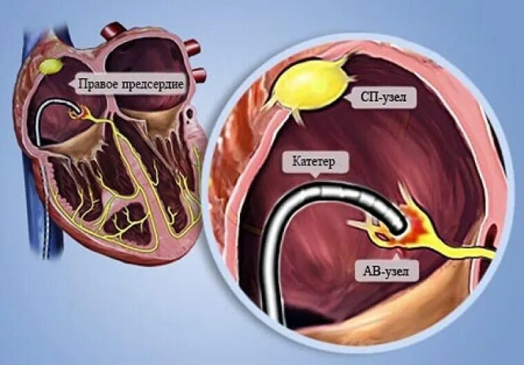 Рча предсердий. Радиочастотная абляция РЧА. Радиочастотная катетерная абляция сердца. Абляция атриовентрикулярного узла. Радиочастотная катетерная абляция (РЧА).