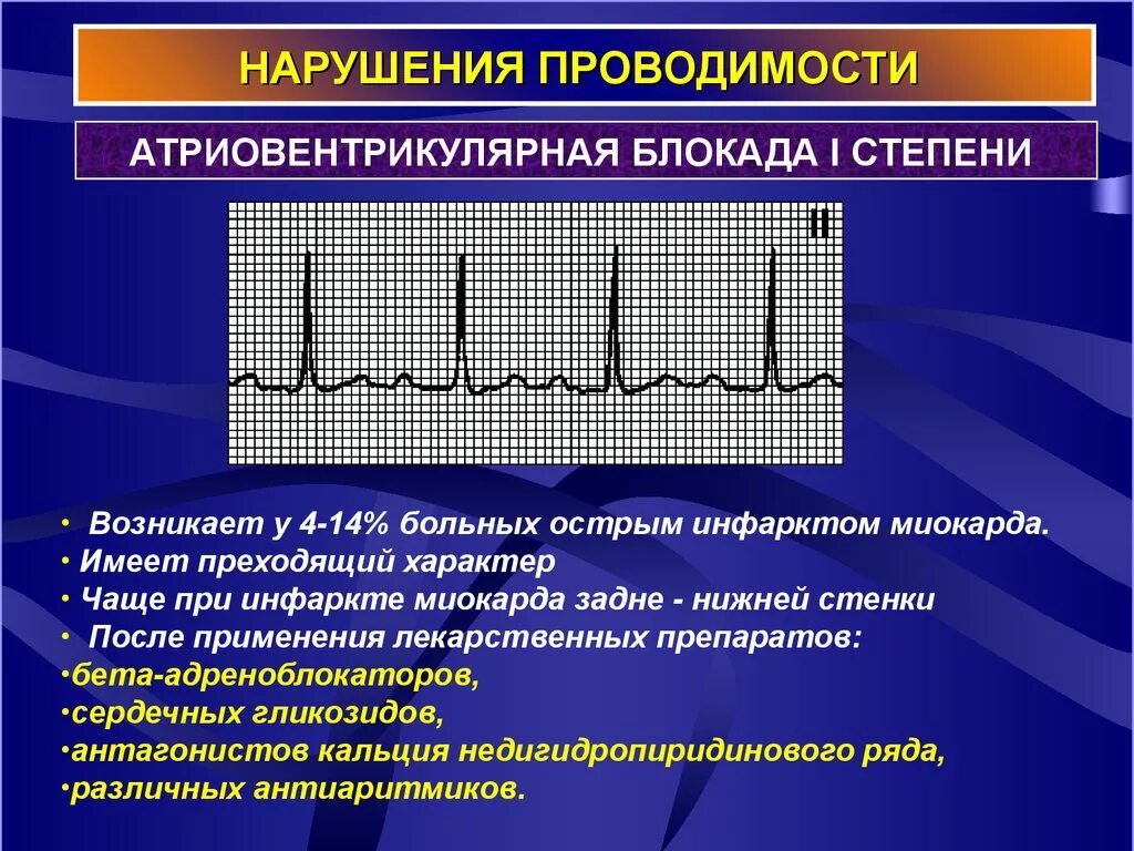 Нарушение атриовентрикулярной проводимости на ЭКГ. Нарушение проводимости сердца атриовентрикулярная блокада. Причины нарушения атриовентрикулярной проводимости. Нарушение функций проводимости сердца ЭКГ.