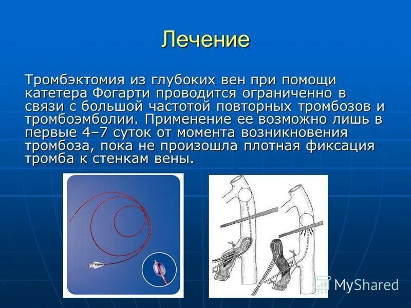 Катетер фогарти. Эндоваскулярная тромбэктомия. Открытая тромбэктомия. Тромбэктомия нижних конечностей.