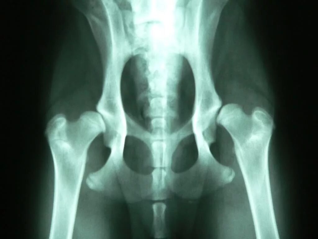 венозная дисплазия тбс. дисплазия суставных поверхностей. дисплазия тазобедренных рентген. дисплазия тазобедренных суставов рентген. дисплазия подвывих тазобедренного сустава.