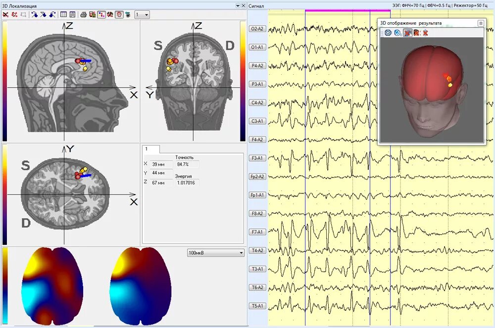 ЭЭГ мониторинг головного мозга. Импульсы головного мозга ЭЭГ. Электроэнцефалограмма головного мозга снимок. Электроэнцефалография головного мозга (ЭЭГ). Электрическая активность головного мозга