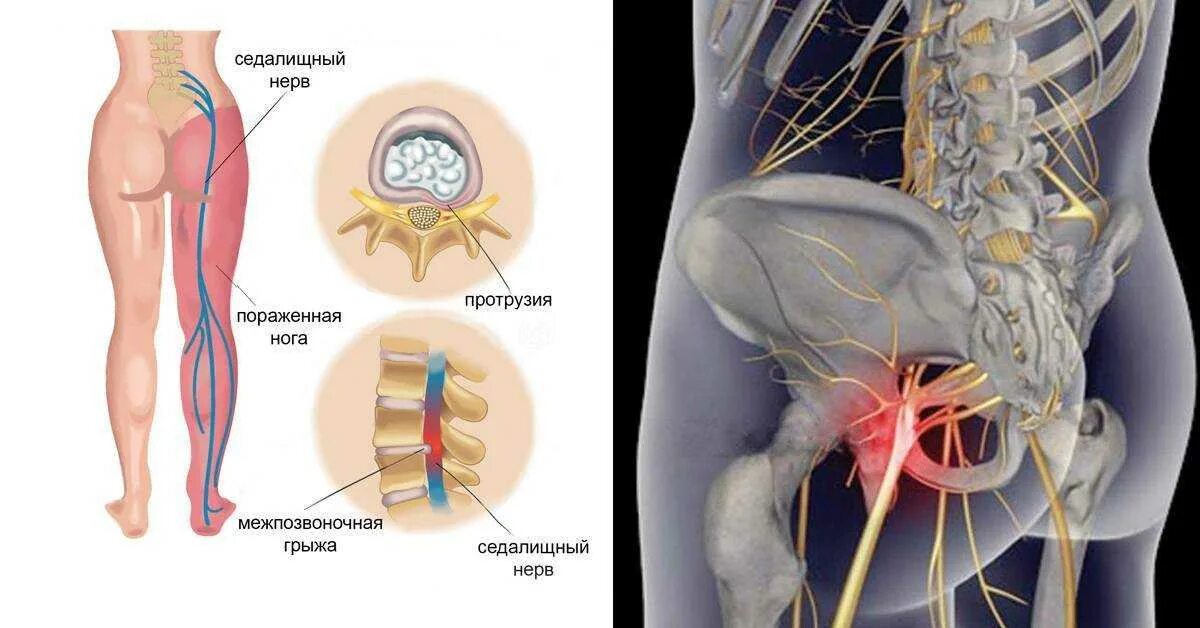 Пояснично крестцовый отдел отдает в ногу. Люмбоишиалгия поясничного отдела позвоночника. седалищный нерв. ишиас - защемление седалищного нерва. защемление седалищного нерва s1.