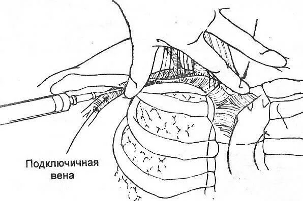 Правая подключичная вена. Подключичная Вена анатомия. Анатомия подключичной вены. Методика пункции подключичной вены. Катетер для подключичной вены.