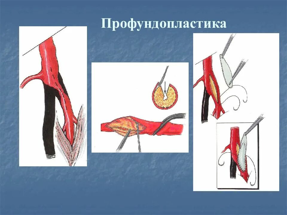 Операция шунтирование нижних. Профундопластика бедренной артерии. Профундопластика ход операции. Бедренно-подколенное шунтирование. Бежренно-бедоенное шунтирование.