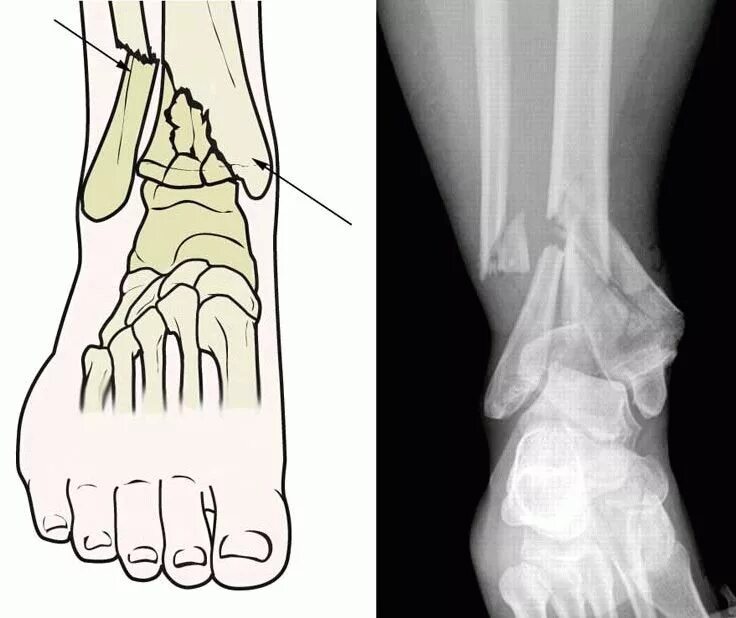 Трещина кости на ноге. Трехлодыжечный перелом голеностопного сустава. Трехлодыжечный перелом голени. Оскольчатый перелом лодыжки. Перелом лодыжки пронация.