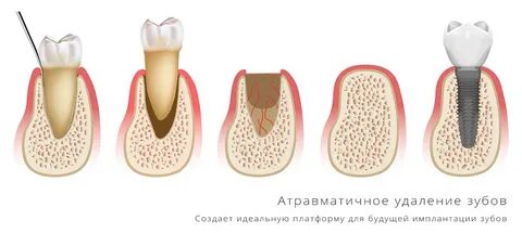 Зубы человека удаление