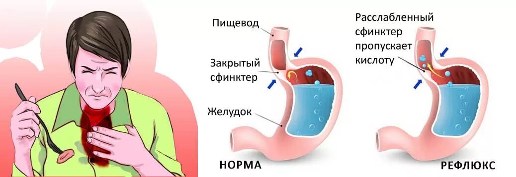 Желудочный сок в пищеводе