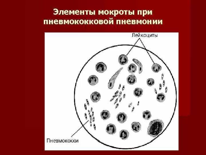 Пневмококки мокрота микробиология. Пневмония микроскопия мокроты. Микробиологическое исследование мокроты. Микроскопия мокроты при крупозной пневмонии.
