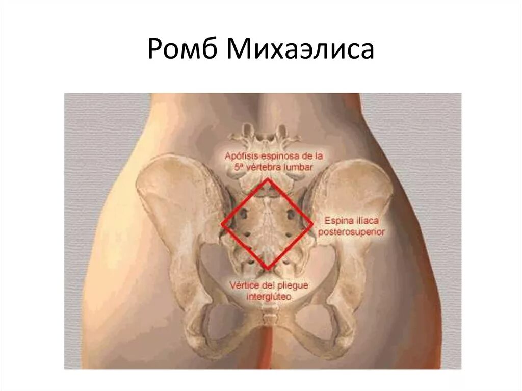 Болит таз мужчины. Измерение крестцового ромба ромба Михаэлиса. Пояснично-крестцовый ромб Михаэлиса. Исследование ромба Михаэлиса (пояснично-крестцового). Ромб Михаэлиса в акушерстве.