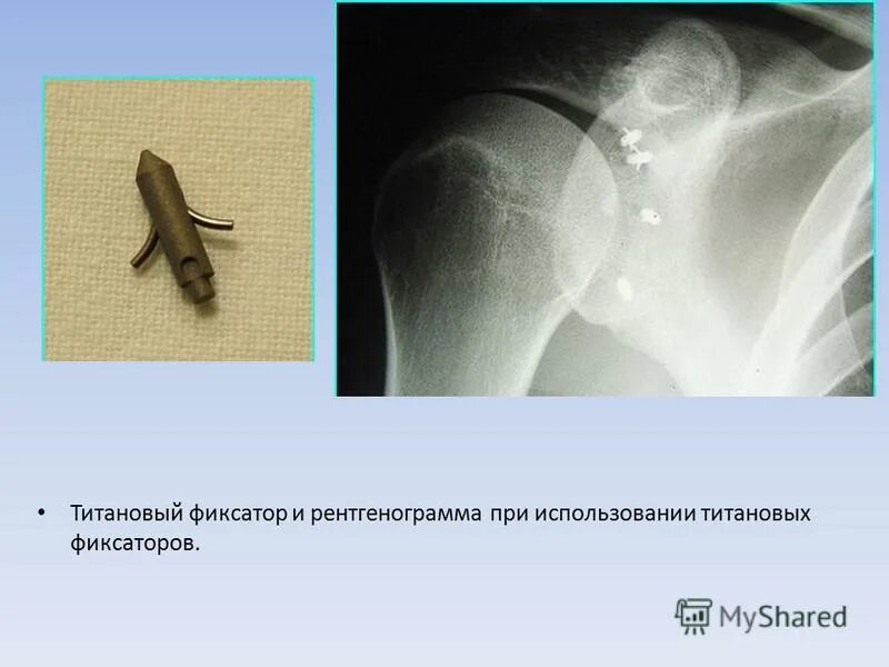 титановый фиксатор. титановые фиксаторы. транспедикулярный остеосинтез позвоночника. транспедикулярная фиксация th11-l2. металлоконструкция в позвоночнике.