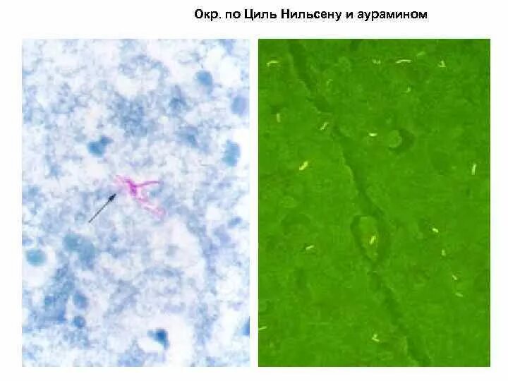 Мокрота по цилю нильсену. Микроскопия по Цилю Нильсену туберкулез. Мазок мокроты по Цилю-Нильсену. Туберкулезные палочки в мокроте окраска по Циль-Нильсену.