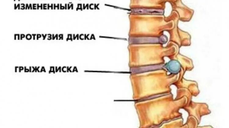 Болит ли протрузия. Блокада межпозвонкового диска и грыжи. Грыжи и протрузии позвоночника. Протрузия крестцового отдела позвоночника. Блокада фасеточного сустава l5-s1.