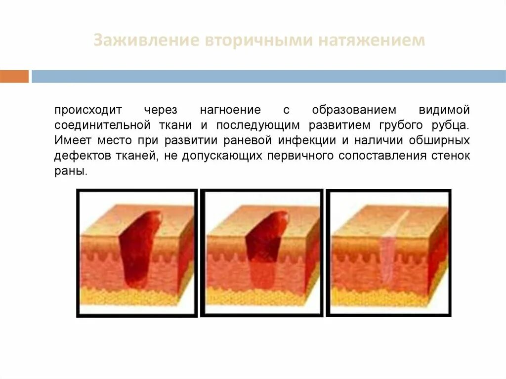 Этапы заживления ран. Соединительная ткань заживление РАН. Заживление РАН вторичным натяжением патанатомия. Первичное и вторичное заживление шва после операции. Этапы заживления рваных РАН.