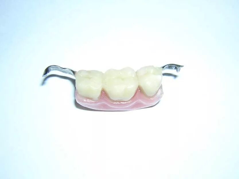 Съемный протез зуба бабочка. Зубной микропротез бабочка. Съемный микропротез 1 зуб. Микропротез бабочка/ иммедиат-протез. Бюгельный протез (2-3 кламмера).