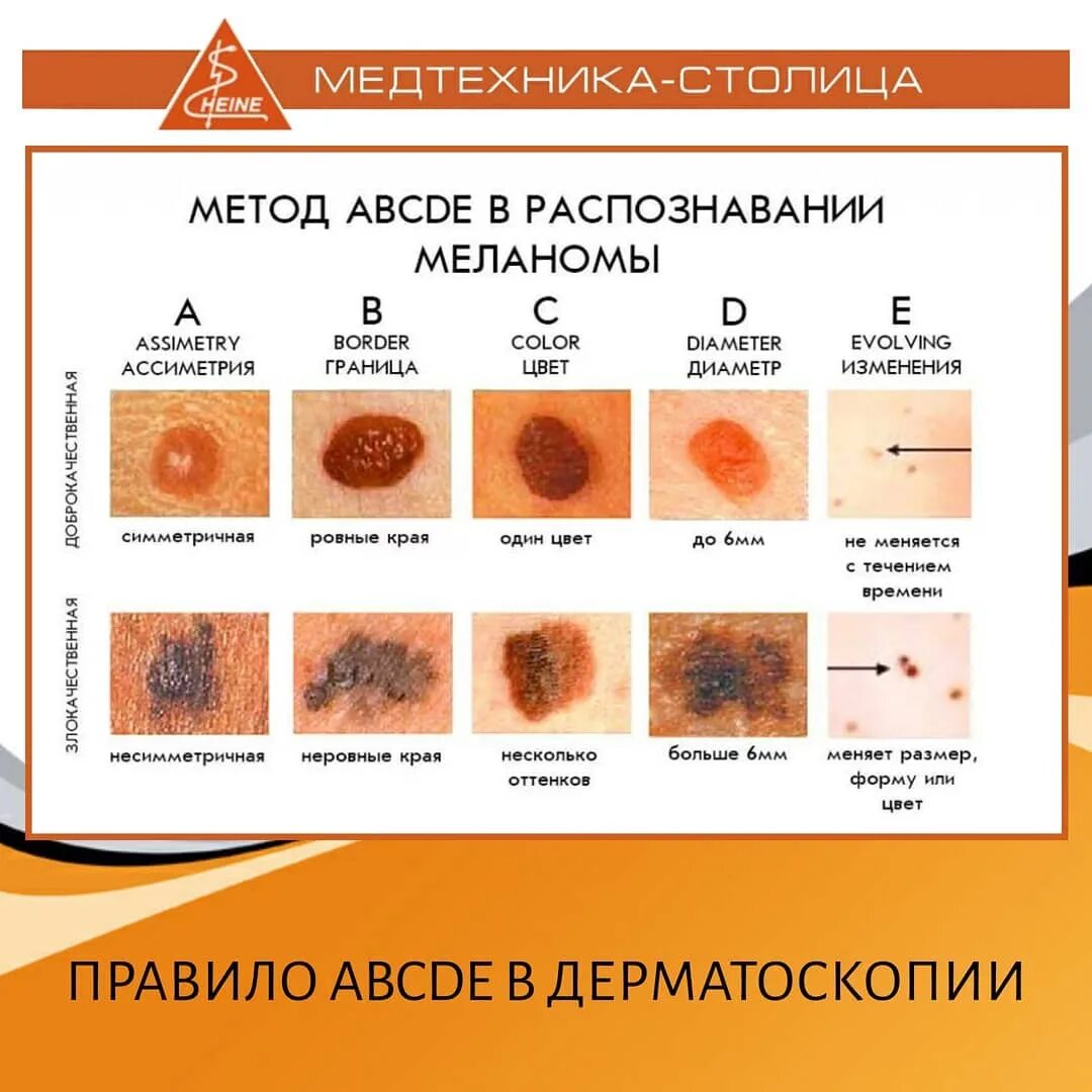 Распад кожи. Меланома кожи дифференциальный диагноз. Меланоцитарные опухоли кожи классификация. Новообразование меланома стадии.