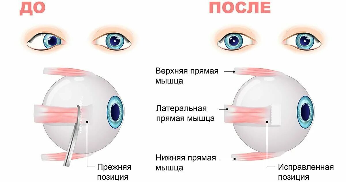 Исправление косоглазия у взрослых операция. Операция по исправлению косоглазия. Глаза после операции по исправлению косоглазия.