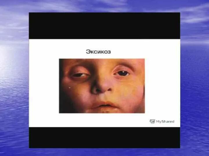 Эксикоз у детей. Эксикоз у детей клиника.