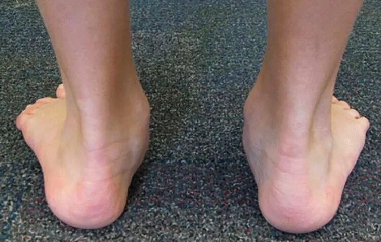 болезнь шинца у детей лечение