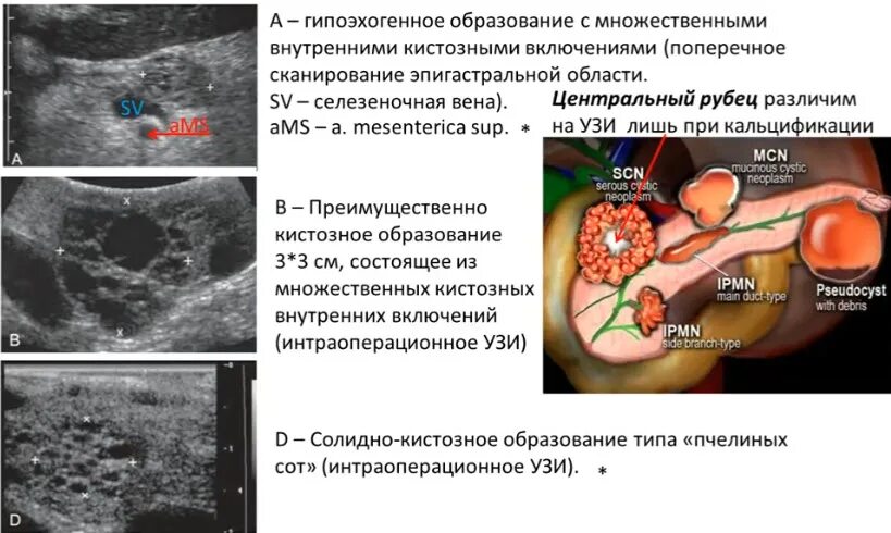 Кистозный солидный образование молочные железа. Внутрипротоковая муцинозная опухоль поджелудочной железы на кт. Цистаденома поджелудочной железы кт. Внутрипротоковая цистаденома поджелудочной железы. Муцинозная цистаденома поджелудочной железы мрт.