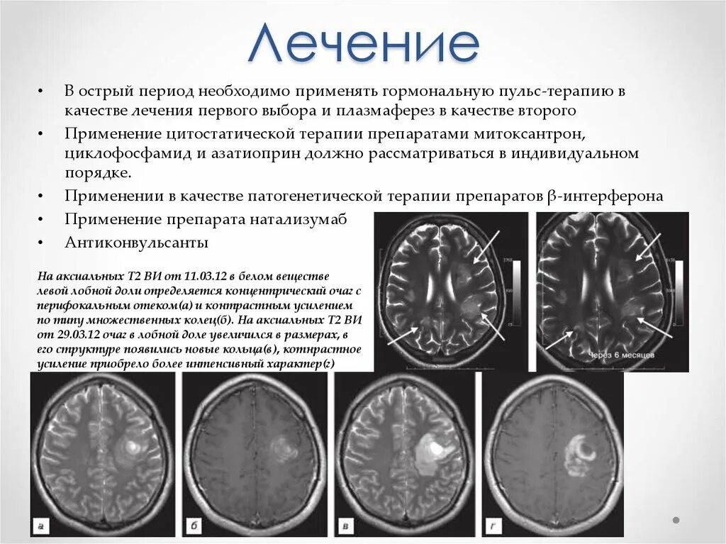 Очаги сосудистого генеза головного мозга что это. Прогрессирующая мультифокальная лейкоэнцефалопатия кт. Мультифокальная лейкоэнцефалопатия головного мозга. Мультифокальная лейкоэнцефалопатия мрт. Лейкоэнцефалопатия головного мозга мрт.