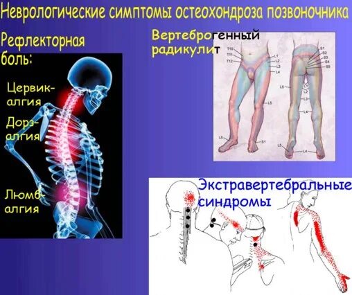 Синдромы остеохондроза поясничного отдела. Локализация остеохондроза. Остеохондроз. Неврологические проявления остеохондроза. Неврологические проявления остеохондроза позвоночника неврология. Синдромы при поясничном остеохондрозе.