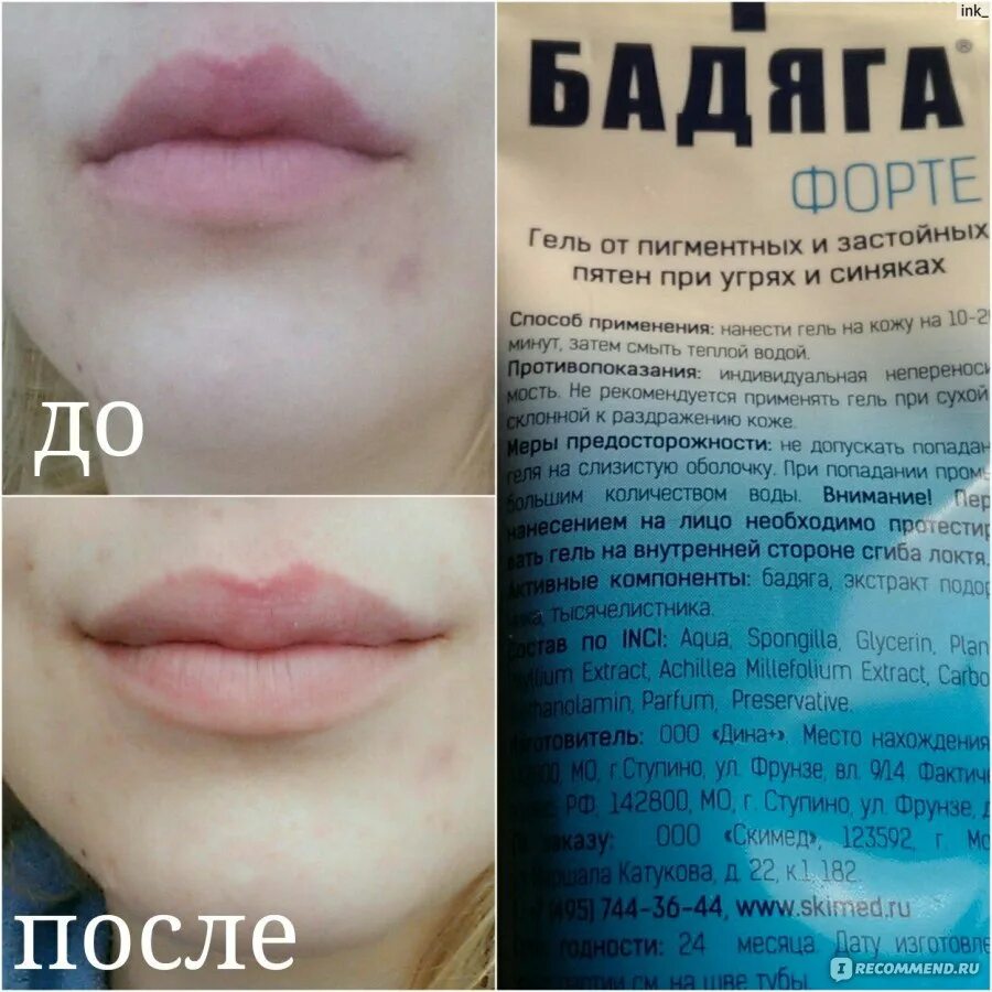 Как быстро и эффективно избавиться от прыщей. Бадяга от пигментных пятен на лице. Средства от пигментных пятен после прыщей. Бадяга от прыщей и пятен. Бадяга от пигментных пятен до и после.