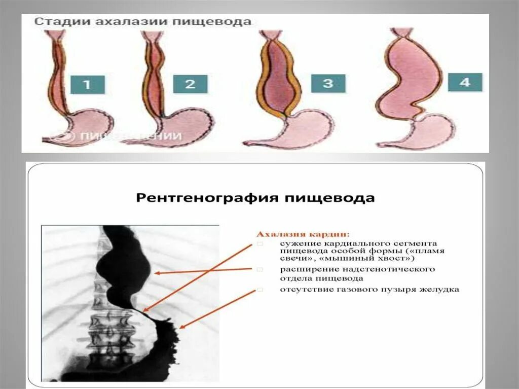 Халазия пищевода. Ахалазия пищевода эндоскопическая классификация. Степени ахалазии кардии на рентгене. Ахалазия кардии эндоскопическая классификация. Ахалазия кардии стадии рентген.