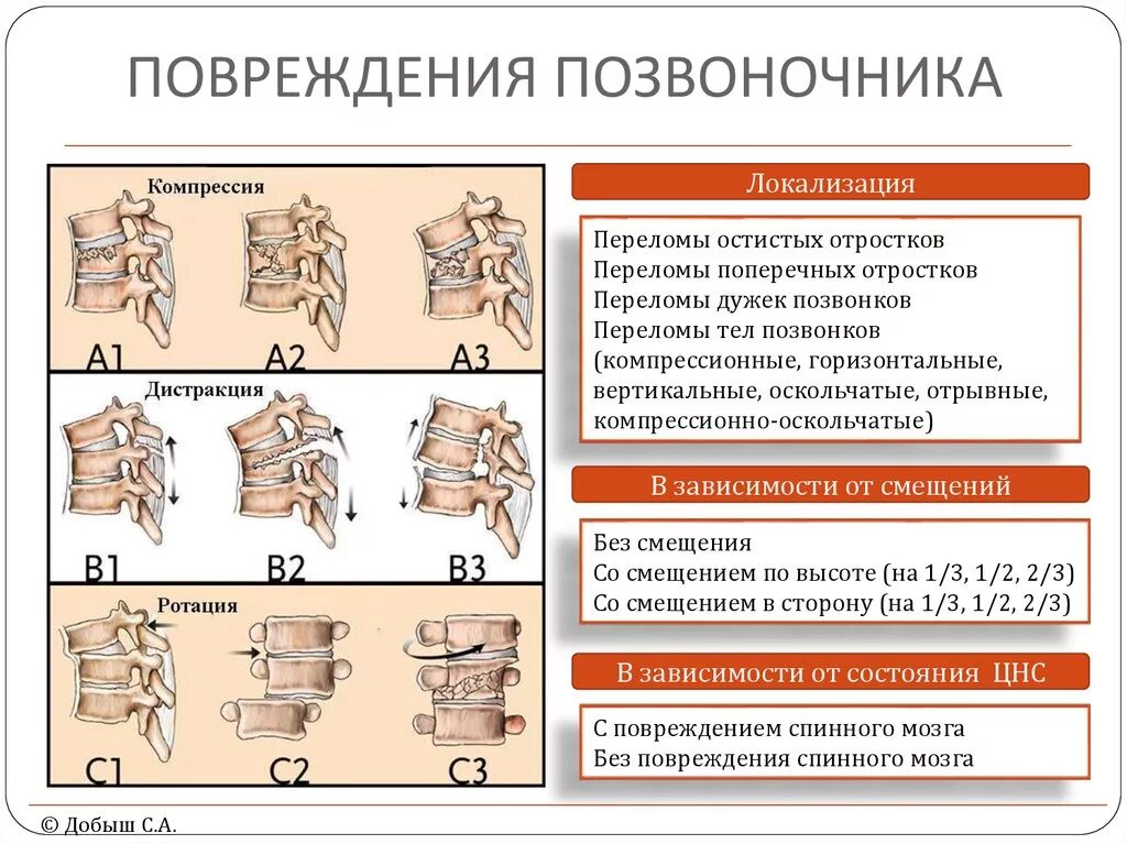 Перелом к какой степени тяжести относится. Классификация компрессионных переломов позвонков. Компрессионный перелом позвоночника классификация. Перелом шейного позвонка классификация. Классификация АО переломов позвоночника.