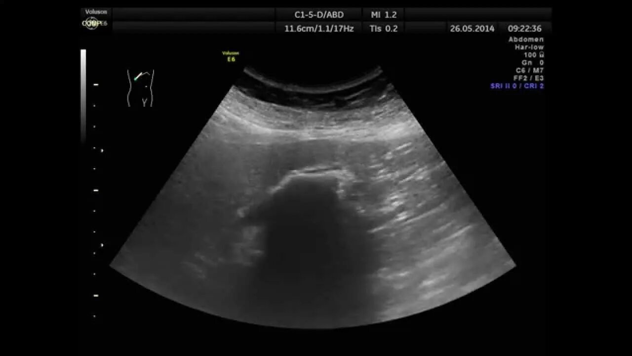Узи жкб. Отключенный желчный пузырь на УЗИ. Выключенный желчный пузырь УЗИ. Отключенный желчный пузырь на УЗИ фото. Эмпиема желчного пузыря на УЗИ.