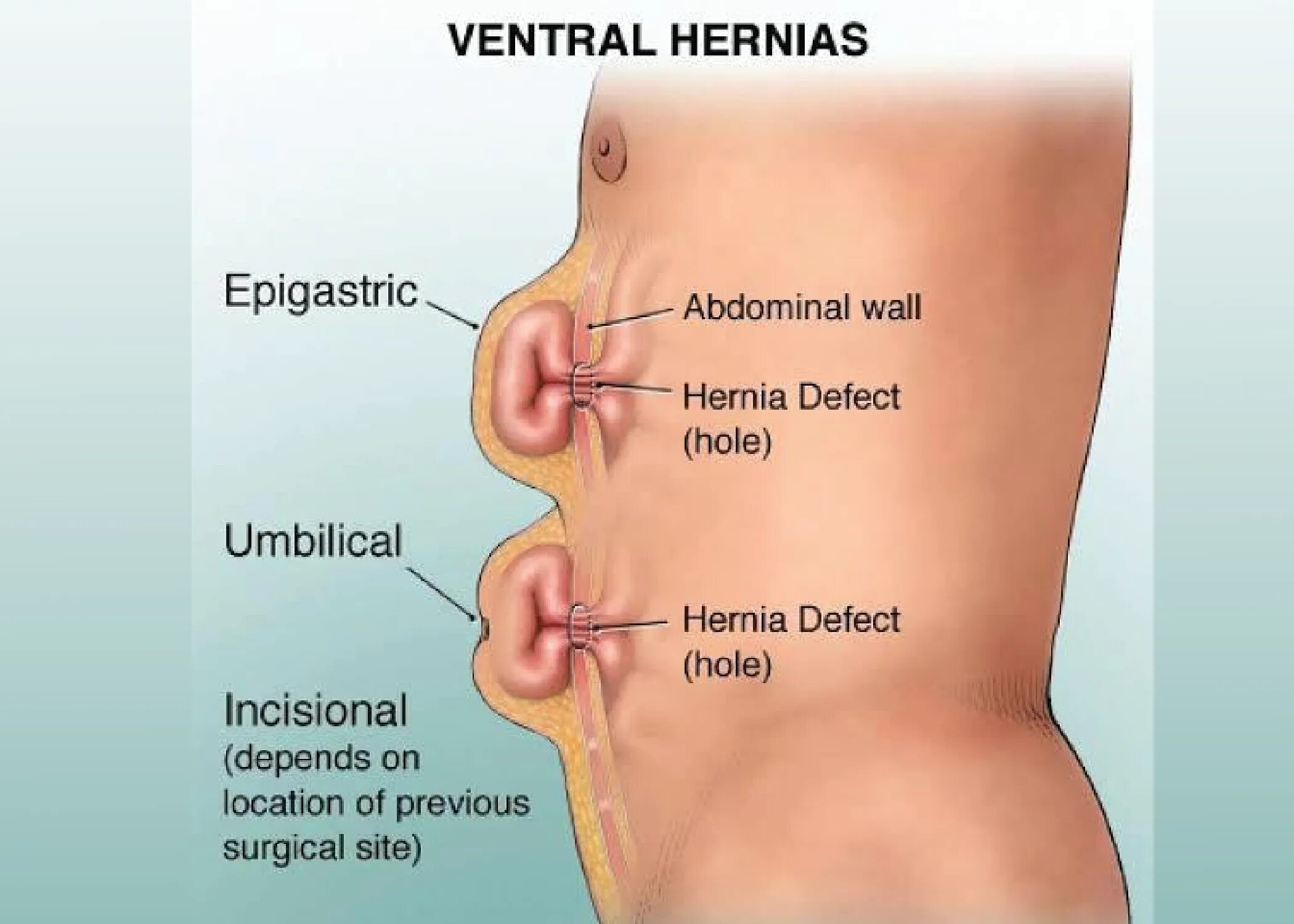 Эпигастральная вентральная грыжа. Грыжа срединной линии живота. Грыжа белой линии надпупочная. Гигантская послеоперационная вентральная грыжа.