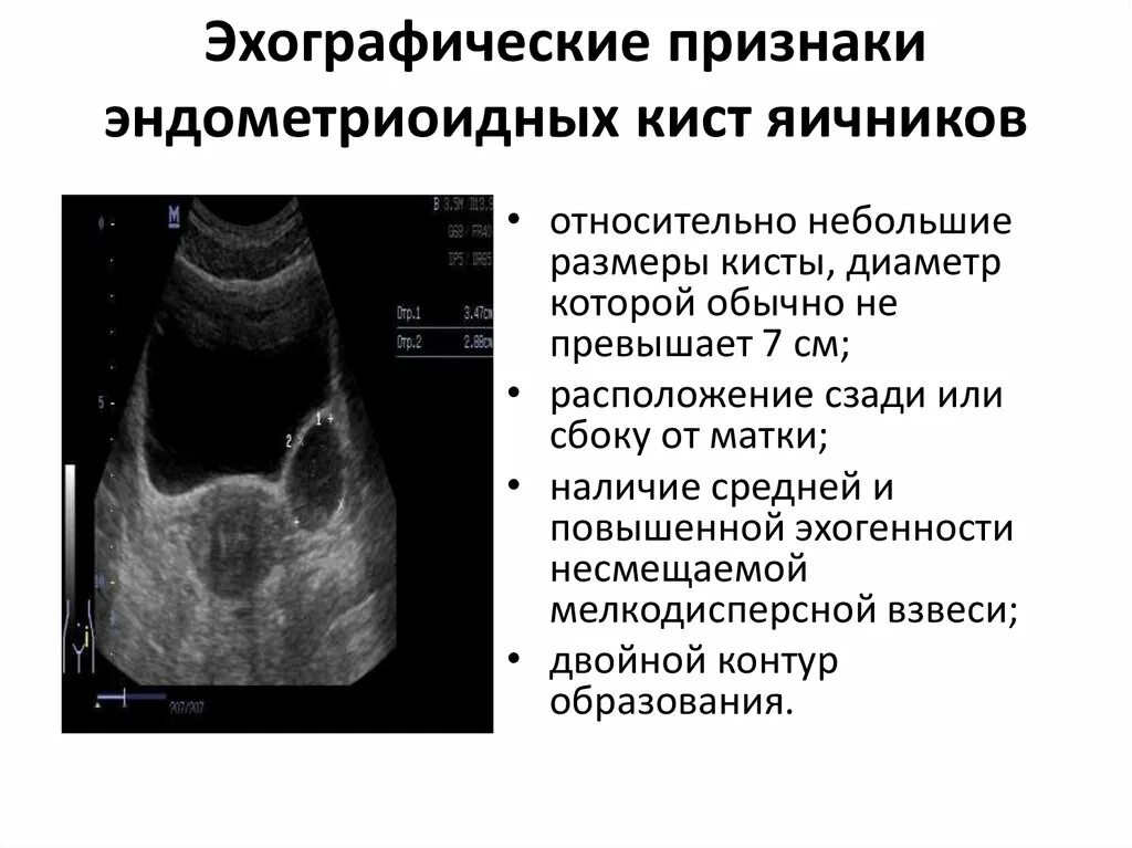 Признаки кистозных изменений. Эндометриоидная киста на УЗИ описание. Эндометриоидная киста яичников симптомы. УЗИ описание эндометриоидной кисты.