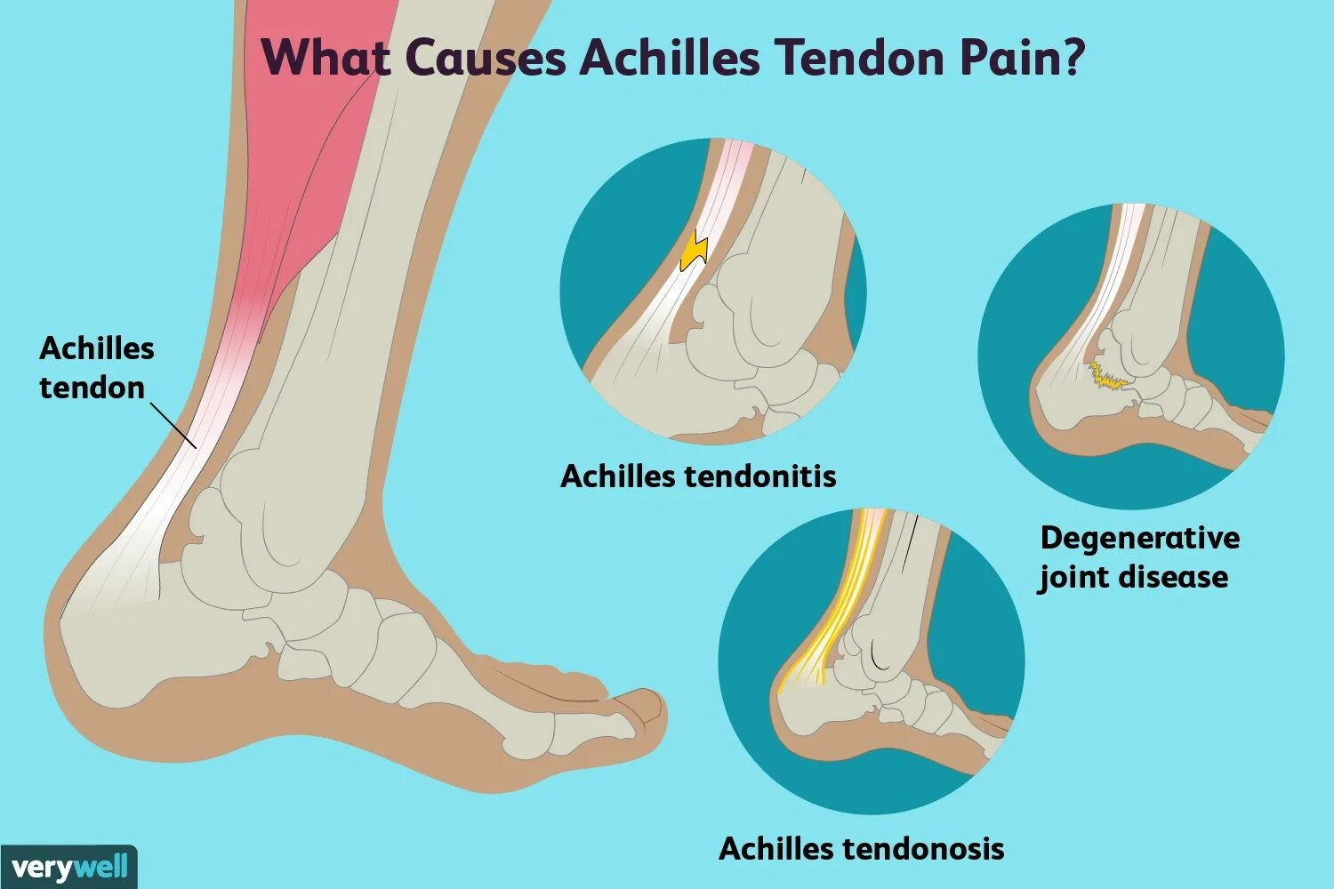 Achilles tendon tendinitis. Ахилл пята