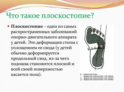 Почему появляется плоскостопие москва