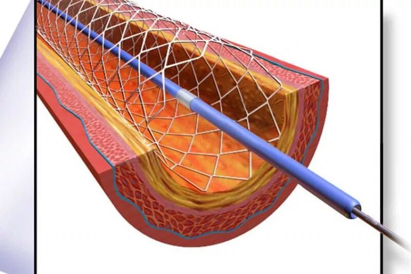 Система доставки стенты. ЧКВ баллонная ангиопластика. Лазерная коронарная ангиопластика. Катетер лазерная ангиопластика.