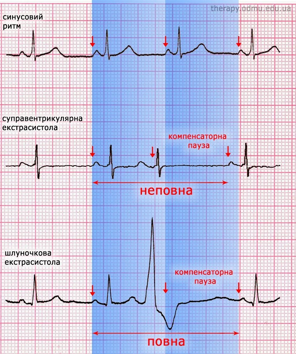 Аберрантные экстрасистолы на ЭКГ. Наджелудочковые экстрасистолы на ЭКГ. Аберрантные комплексы на ЭКГ. Желудочковые и наджелудочковые экстрасистолы. Аберрантные экстрасистолы