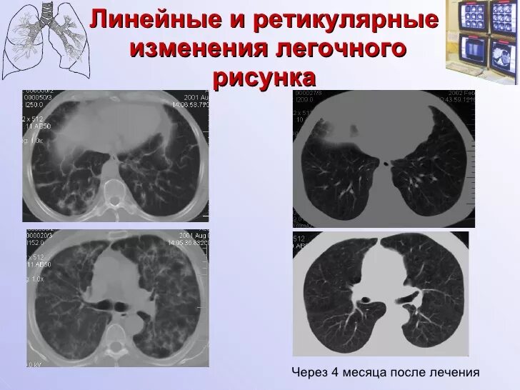 Изменения базальных отделов легких. Идиопатический пневмофиброз. Легочный фиброз кт. Ретикулярные изменения в легких кт. Посттуберкулезный пневмофиброз.