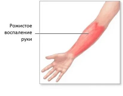 Прогноз рожи