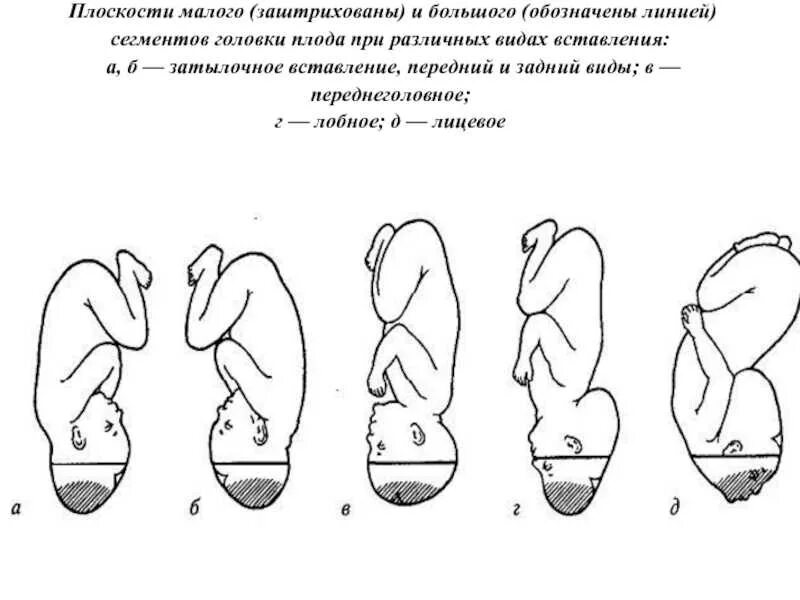 Неправильное предлежание головки плода. Вставление головки плода. Плоскости головки плода. Сегменты головки плода. Переднеголовное предлежание