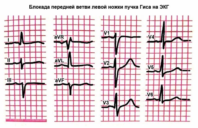 Неполная блокада передней. Блокада ветвей левой ножки пучка Гиса на ЭКГ. Неполная блокада передней ветви ЛНПГ на ЭКГ. Блокада передней ветви ЛНПГ на ЭКГ. Блокада передней ветви ЛНПГ на ЭКГ признаки.