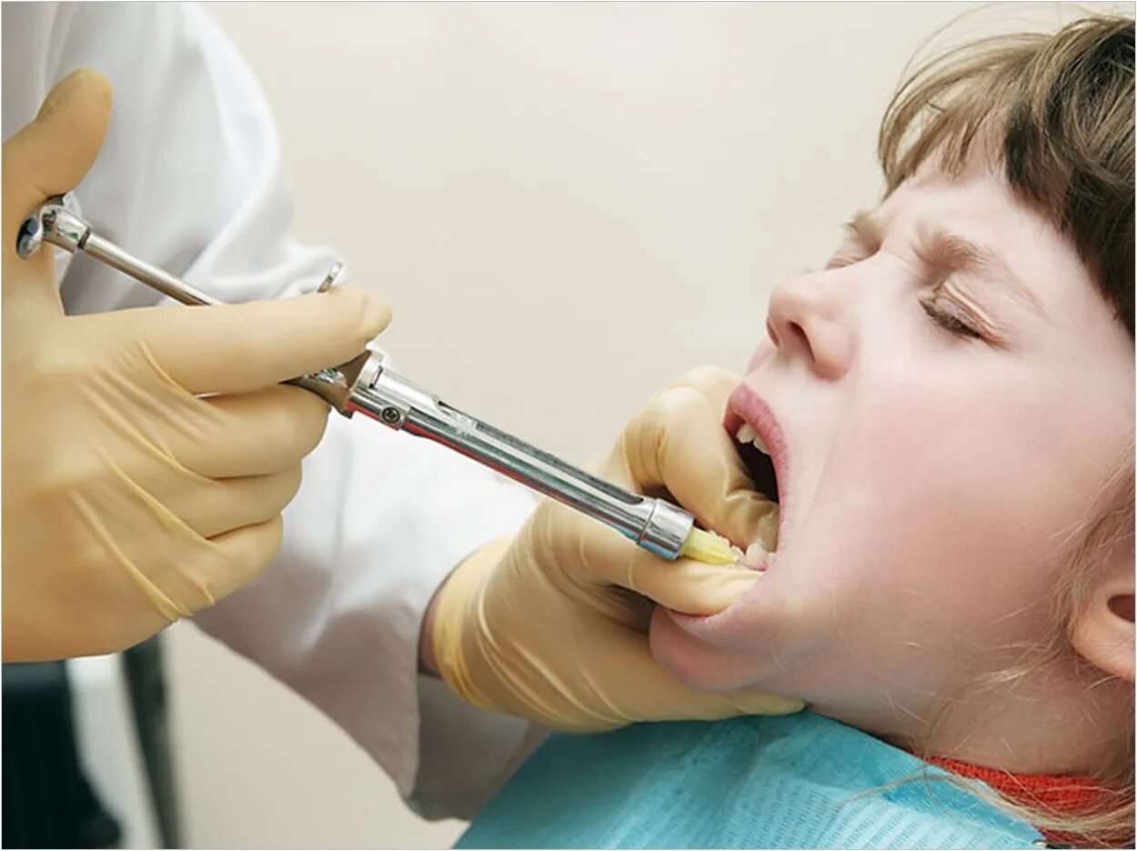 Анестезия полости рта. Инфильтрационная анестезия стом. Местная анестезия в стоматологии. Анестизия в стоматология.