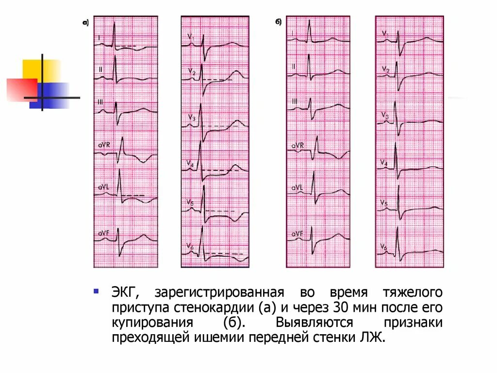 Стенокардия напряжения изменения на ЭКГ. Нестабильная стенокардия ЭКГ. ЭКГ при стенокардии напряжения 2 ФК. ЭКГ при ИБС стенокардия напряжения 2 ФК. Тяжелое экг