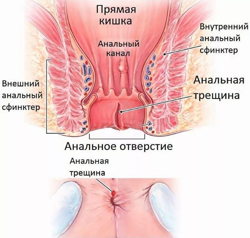 Сфинктерит прямой кишки симптомы. Причины трещин заднего прохода. анальная трещина (трещина заднего прохода). наружный сфинктер прямой кишки. геморрой в заднем проходе.