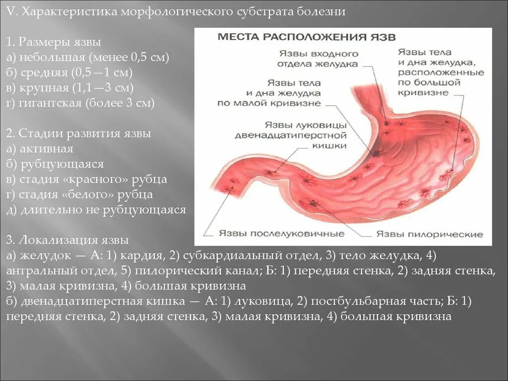 Язвы двенадцатиперстной кишки на стенке луковицы. Язвенная болезнь желудка и 12 перстной. Язва желудка луковицы двенадцатиперстной кишки. Пилорическая язва желудка.