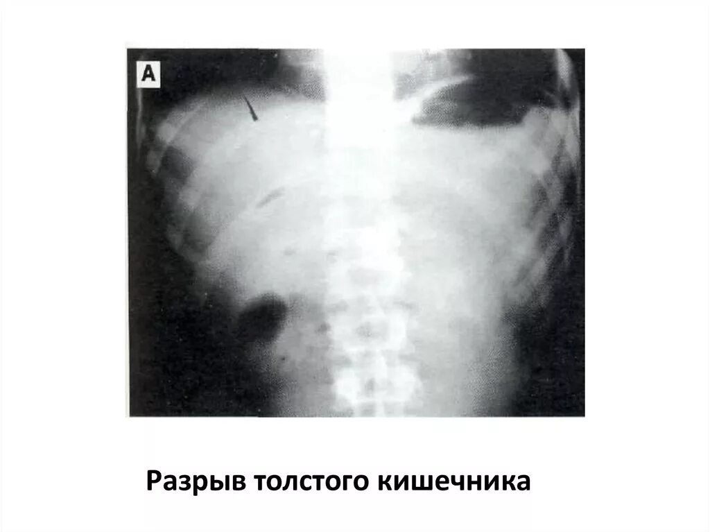 Разрыв кишечника разрыв. Разрыв тонкого кишечника.