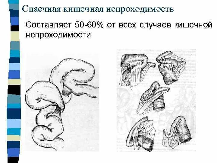 Острая кишечная непроходимость спайки. Лечение спаечной кишечной непроходимости операция. Острая спаечная кишечная непроходимость симптомы. Кишечная непроходимость тонкокишечная.