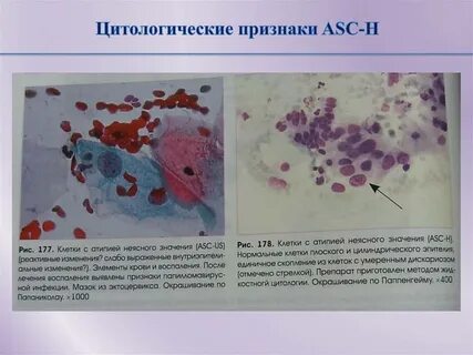 Клетки при гнойном воспалении